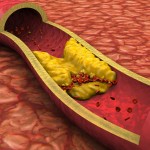 Atherosclerotic Plaque Deposits